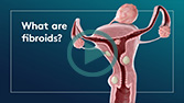 What is a Fibroid?